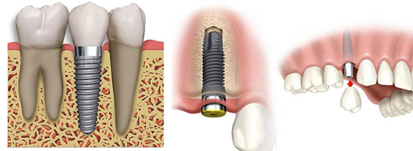 imagen Implante dental